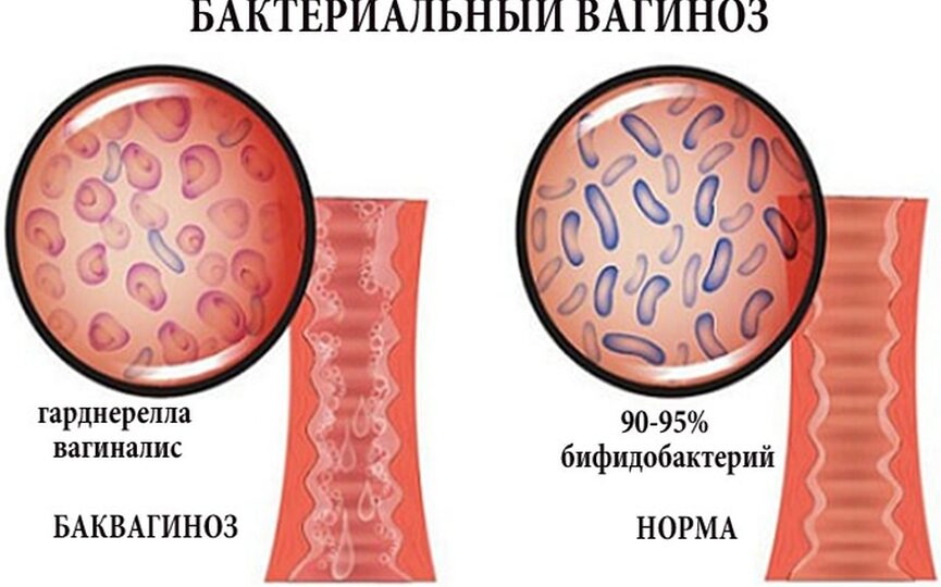Что такое бактериальный вагиноз?